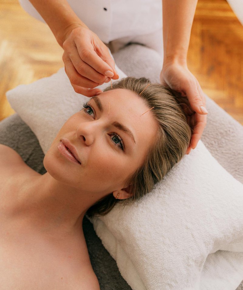 Facial Acupuncture  Herndon, VA