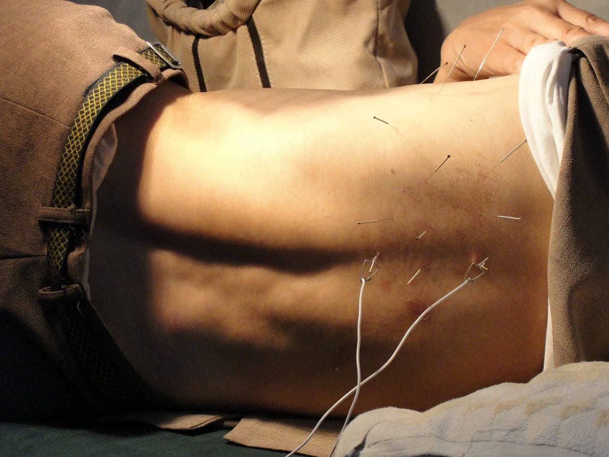Electroacupuncture  Herndon, VA